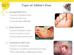 athlete s foot know more about its
