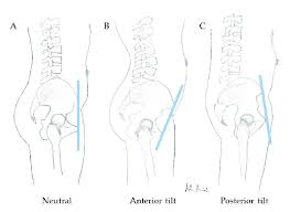 True and false pelvis (lesser and greater pelvis). Neutral A Anterior B And Posterior C Pelvic Tilt Appt Download Scientific Diagram