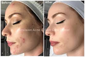 skin care acne treatment