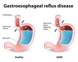 gerd gastrointestinal reflux disease