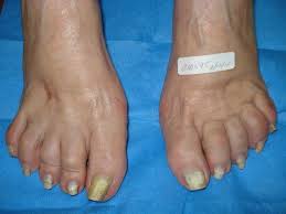 laser treatment for toenail fungus in