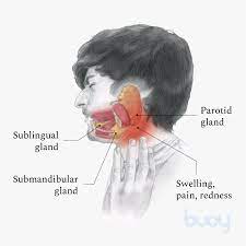 symptoms of salivary gland disorder and
