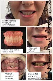 You can get them on any time after you get teeth pulled, many people get teeth pulled while they already have braces. Immediate Dentures Denture Clinic Melbourne