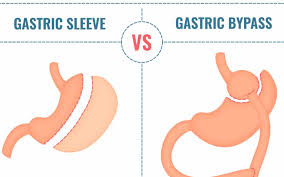 gastric byp v sleeve gastrectomy