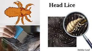 health tips to treat and prevent lice