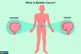 An Overview Of Bladder Cancer