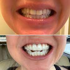 Overbites can even be acquired later in life from years of engaging in harmful habits like chewing on the fingernails. Thought I Was Too Old To Fix My Overbite And Tmj My Teeth After Only 10 Days Invisalign