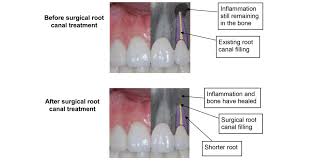surgical endodontic root c