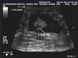 ultrasound of cleft lip and palate