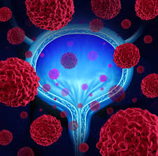 Blue Light Cystoscopy Increases Bladder Cancer Detection