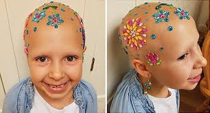With this condition, your body mistakenly views your hair. 7 Year Old Girl With Alopecia Shows How Baldness Is Beautiful