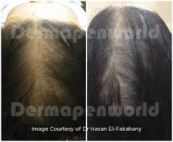 women alopecia hair loss