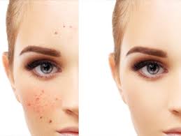 Our dermatologists speak spanish, are have cosmetic backgrounds, and take pride in being your doctor for your skin. Best Skin Care Clinic In Chennai Satin Skin Care Clinic
