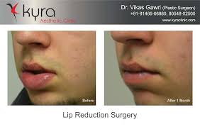 lip reduction surgery in toronto