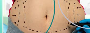 liposuction after a tummy tuck is it