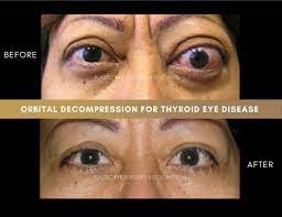 thyroid eye disease photos plastic