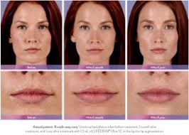 fillers for lips in new jersey soma