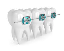 Please note that this sub is for patients, so you won't really find professional help here. Adult Braces Types Costs Benefits Newmouth