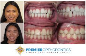 An expander is fit by your orthodontist. Can Invisalign Fix Overbites And Other Bite Problems Premier Orthodontics