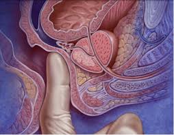 Undersökning av prostata med finger