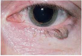 benign tumors of the eyelid epidermis
