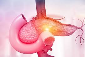 Pancreatic cancer may not have any symptoms, or they might be hard to spot. Pancreatic Cancer Treatment Symptoms Cause Stages Survival Rates