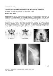 pdf nail patella syndrome ociated