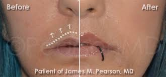 corner lip lift dr james pearson
