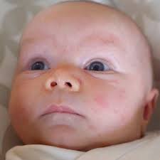 baby acne what causes it how to