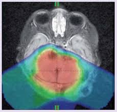 proton therapy for the treatment of