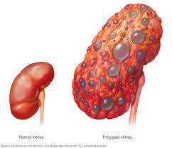 It may cause kidney damage, kidney failure, and high blood pressure. End Stage Renal Disease Symptoms And Causes Mayo Clinic