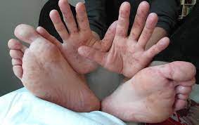 Infected infants and children may present with fever, mouth/throat ulcers, rashes and vesicles on hands and feet. 7 Important Facts About Hand Foot And Mouth Disease Hfmd