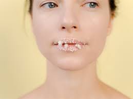 eczema on lips types symptoms