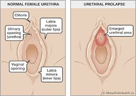 A lesson in female anatomy. Urethral Prolapse