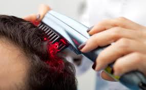 We can safely use these lights to promote hair restoration for patients with androgenic alopecia (female pattern hair loss), traction alopecia, and telogen effluvium. Laser Hair Loss Treatment In Malaysia Lllt Toppik Malaysia