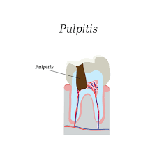 پالپیت Pulpitis