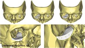 patient specific implants in orbital