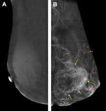 However, several imaging and clinical features can help narrow the differential diagnosis (algorithm 16.1). Breast Metastasis From Malignant Pleural Mesothelioma A Rare Challenging Entity Journal Of Thoracic Oncology