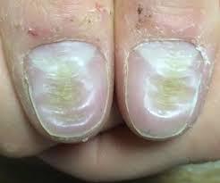 an nail dystrophy and habit tic