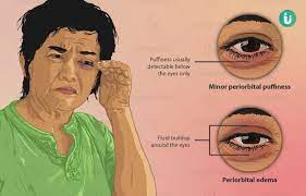 swollen eyes symptoms causes