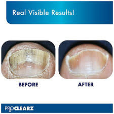 pro clearz brite now fungal nail