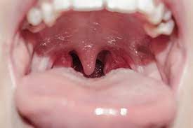 ps on the back of tongue causes