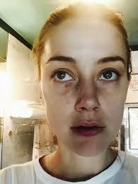 amber heard s bruised face pictured as