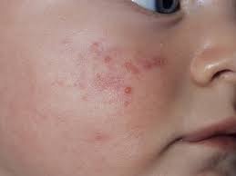 baby acne milia erythema toxi and