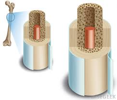 Compact bone, as opposed to spongy bone, is made of cylindrical units, called osteons, that are tightly formed together. What Is Spongy Bone With Pictures