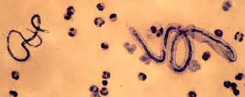 Image result for squiggle in my eye