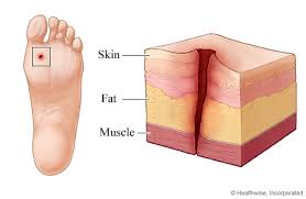 puncture wound health library