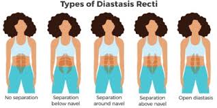 This is how a diastasis recti related to pregnancy commonly presents. Diastasis Recti In Pregnancy Ab Separation Causes Treatment