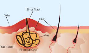 how to get rid of pilonidal cysts