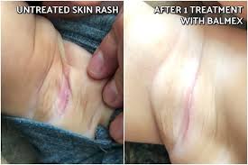 how to get rid of diaper rash and